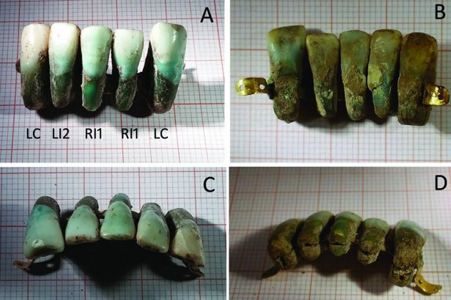 The dentures found in the tomb are the first example of dentures from this historical period, and as such are a valuable addition to the history of dentistry. Image Credits: Photo: University of Pisa via The Local