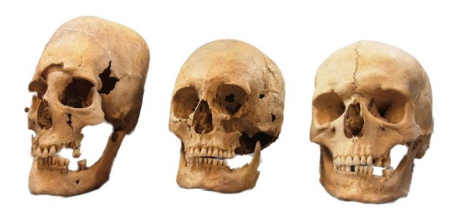 These are strong, intermediate, and non-deformed skulls (from left to right) from the Early Medieval sites Altenerding and Straubing in Bavaria, Germany. Credit: State Collection for Anthropology and Palaeoanatomy Munich
