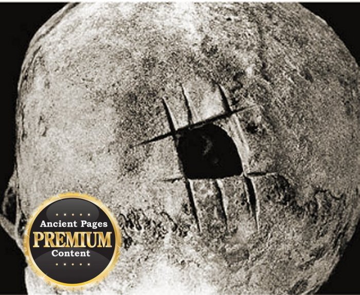 Prehistoric Surgery: Skull Operations Technically Superior To Our Own