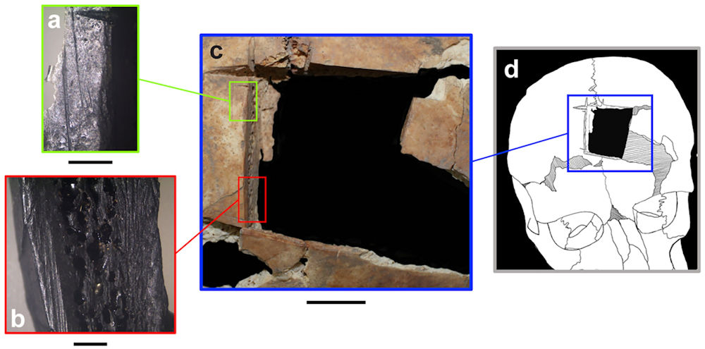 Evidence Of Brain Surgery Performed 3,000 Years Ago Discovered In Tel Megiddo, Israel